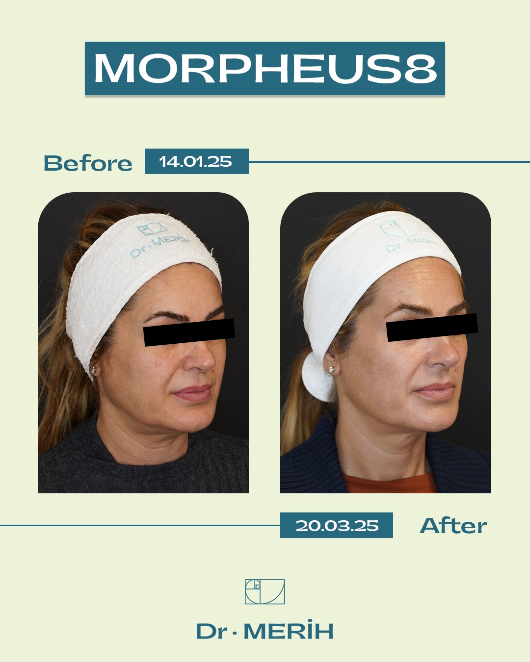 Morpheus8 aims for a firmer, more vibrant, and renewed appearance of the skin. ✨We are observing the changes in the skin between the first assessment on January 14, 2025, and the follow-up on March 20, 2025.Morpheus8, which combines microneedling and radiofrequency technology, is an advanced application used for skin tightening, renewal, and supporting skin quality.The treatment process is planned individually according to the person's skin type, needs, and expectations. Results may vary from person to person.For detailed information and a personalized assessment, please contact our clinic.-Morpheus8 ile ciltte daha sıkı, daha canlı ve yenilenmiş bir görünüm hedeflenir. ✨14 Ocak 2025 tarihinde yapılan ilk değerlendirme ile 20 Mart 2025 tarihindeki kontrol sürecinde ciltteki değişimi gözlemliyoruz.Mikroiğneleme ve radyofrekans teknolojisini bir araya getiren Morpheus8; cilt sıkılaştırma, yenileme ve cilt kalitesinin desteklenmesine yönelik kullanılan gelişmiş bir uygulamadır.Uygulama süreci; kişinin cilt yapısı, ihtiyaçları ve beklentileri doğrultusunda kişiye özel olarak planlanır. Elde edilen sonuçlar kişiden kişiye farklılık gösterebilir.Detaylı bilgi ve kişiye özel değerlendirme için kliniğimizle iletişime geçebilirsiniz.📞 0533 522 56 26 & 0543 664 56 26
📧info@drmerihtombul.com
🌐 drmerihtombul.com#Morpheus8 #BeforeAfter #AmeliyatsızYüzGençleştirme #CiltSıkılaştırma #DrMerihTombul