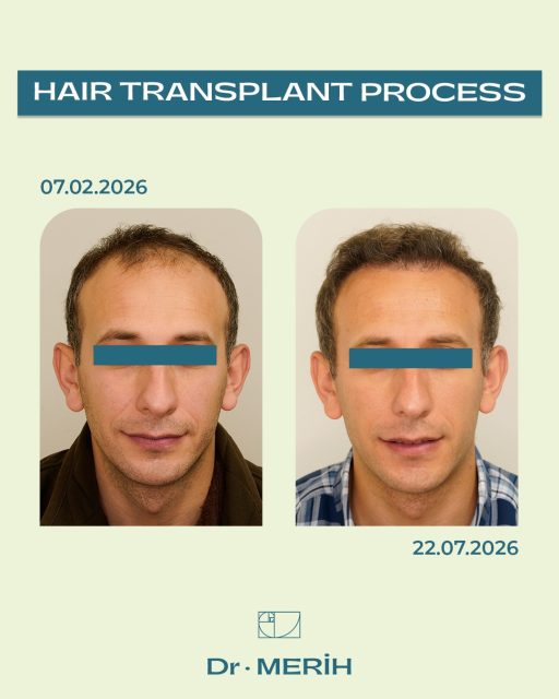 The natural growth process following a hair transplant requires patience and regular follow-up. 🌿Our patient’s hair transplant procedure was performed on February 7, 2026, and the follow-up check-up took place on July 22, 2026.We are sharing images showing the progress made during this period. Results may vary from person to person, and the final appearance continues to develop over time.-Saç ekimi sonrası doğal gelişim süreci sabır ve düzenli takip ister. 🌿Hastamızın saç ekimi işlemi 07.02.2026 tarihinde gerçekleştirildi, kontrolü ise 22.07.2026 tarihinde yapıldı.Bu süreçte gelinen noktayı görüntüleriyle paylaşıyoruz. Sonuçlar kişiden kişiye farklılık gösterebilir ve nihai görünüm zaman içerisinde gelişmeye devam eder.📞 0533 522 56 26 & 0543 664 56 26​
📧 info@drmerihtombul.com​
🌐 drmerihtombul.com​#SaçEkimi #SaçEkimiSonrası #BeforeAfter #HairTransplant #DrMerihTombul​